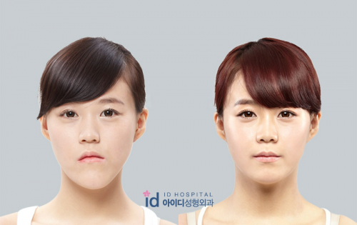 韩国整容中的双鄂手术和面部轮廓手术到底是什